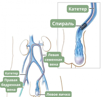 Варикоцеле у мужчин 3