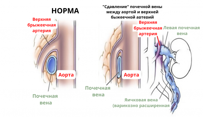 Варикоцеле 3